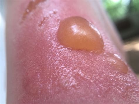 why is my sunburn leaking yellow|Sunburn Blisters: Symptoms, Treatments, and Complications